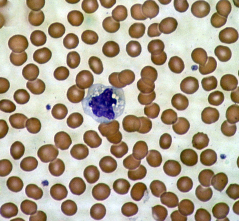 显微镜下的血细胞：红细胞围绕着一个免疫系统的细胞。  